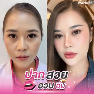 รีวิวฟิลเลอร์