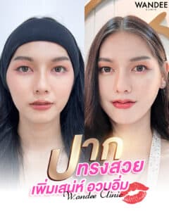 รีวิวฟิลเลอร์