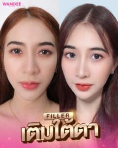 รีวิวฟิลเลอร์