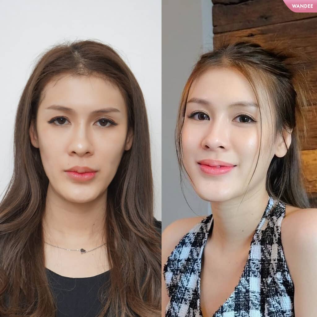 รีวิวฟิลเลอร์