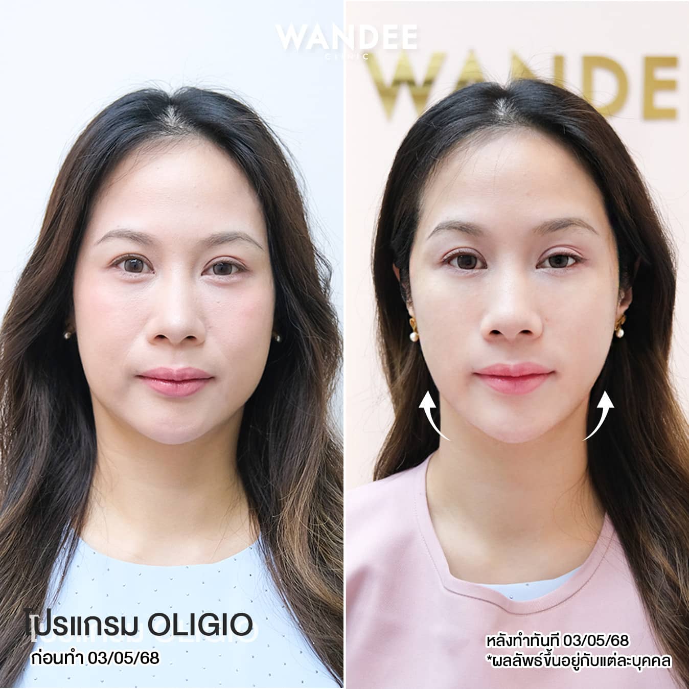 ผลลัพธ์ก่อน-หลัง ทำโปรแกรม Oligio วันดีคลินิก