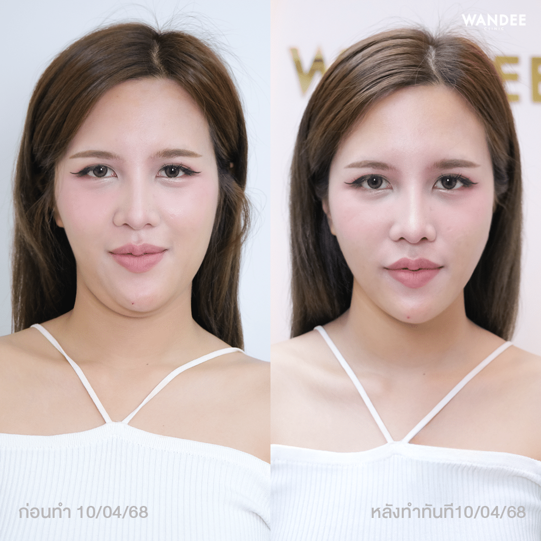 ผลลัพธ์ก่อน-หลัง ทำโปรแกรม Oligio วันดีคลินิก
