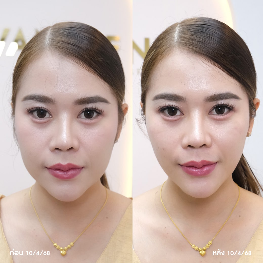 ผลลัพธ์ก่อน-หลัง ทำโปรแกรม Oligio วันดีคลินิก
