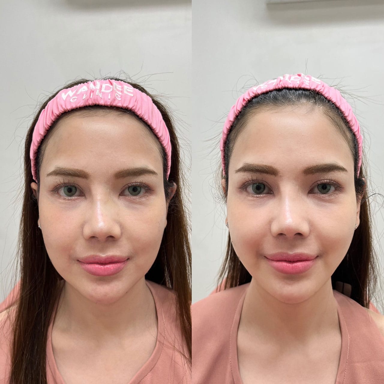 ผลลัพธ์ก่อน-หลัง ทำโปรแกรม Oligio วันดีคลินิก