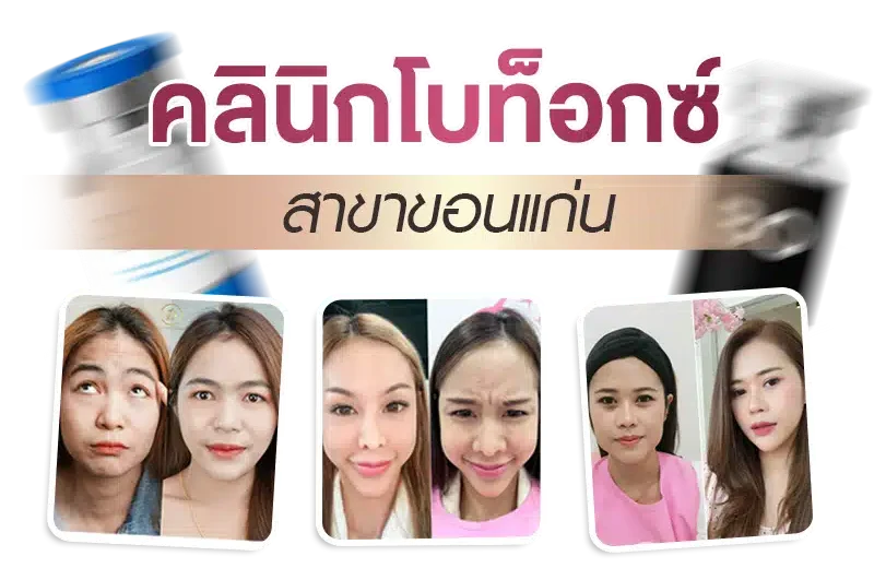 คลินิกโบท็อกซ์ ขอนแก่น