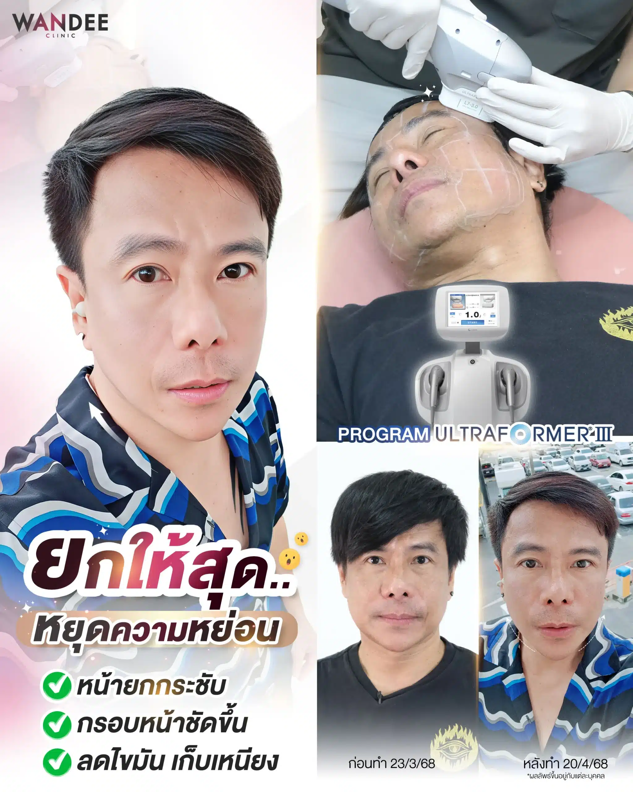 Ultraformer iii ขอนแก่น