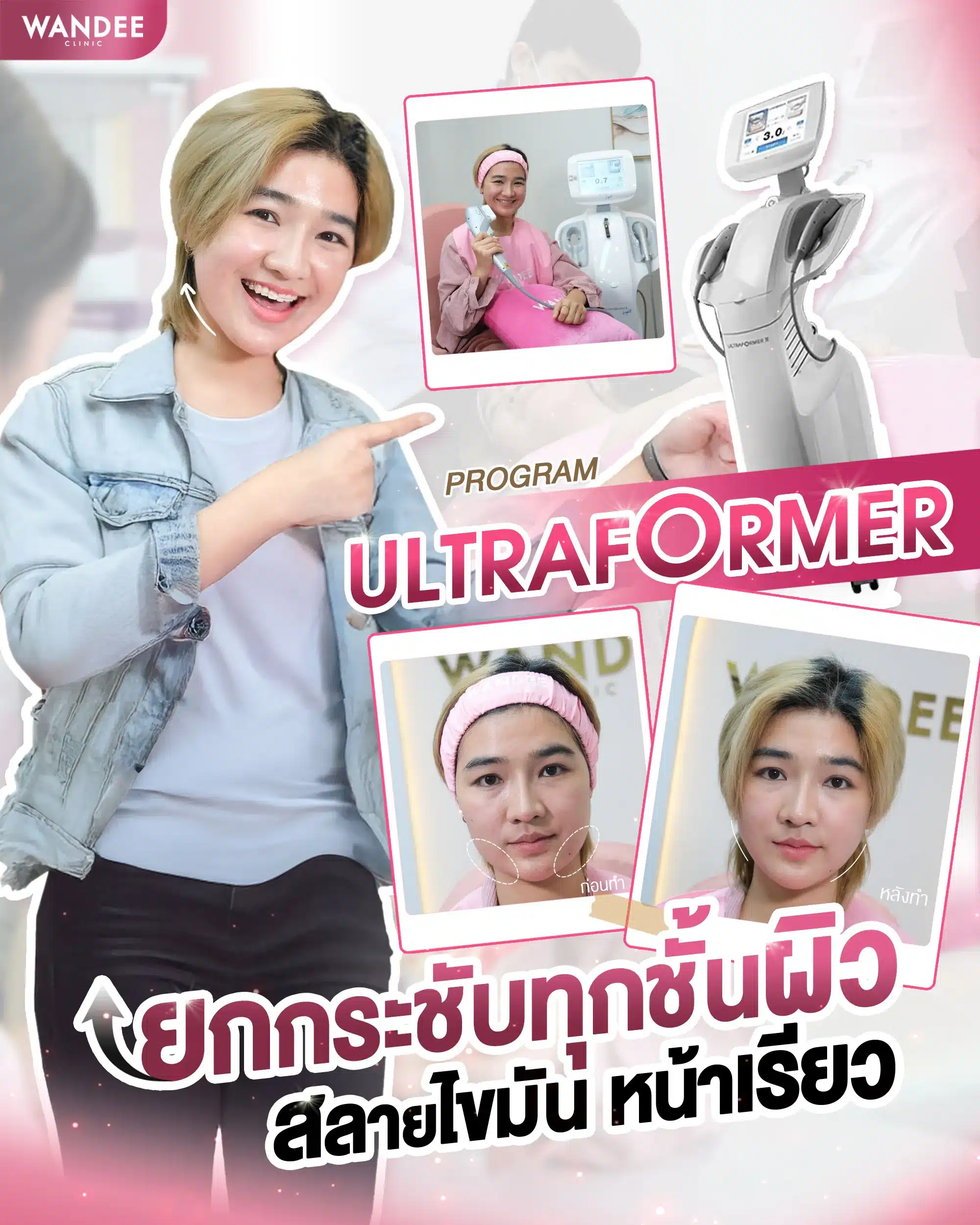 Ultraformer iii ขอนแก่น
