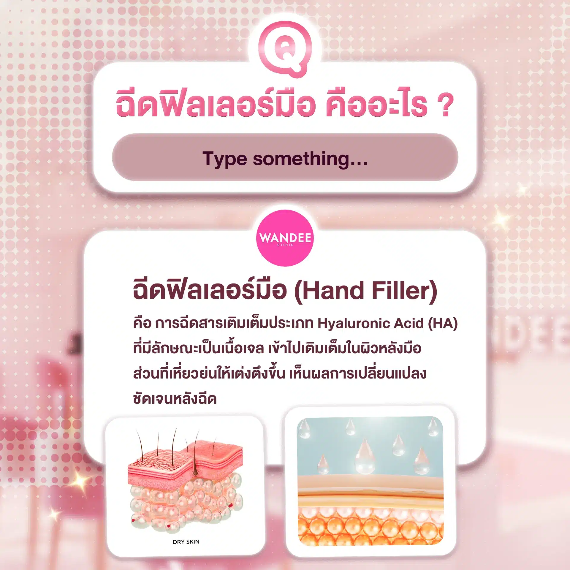 ฉีดฟิลเลอร์มือ ขอนแก่น ที่ไหนดี? ฟิลเลอร์มือ ช่วยเรื่องอะไรบ้าง ?