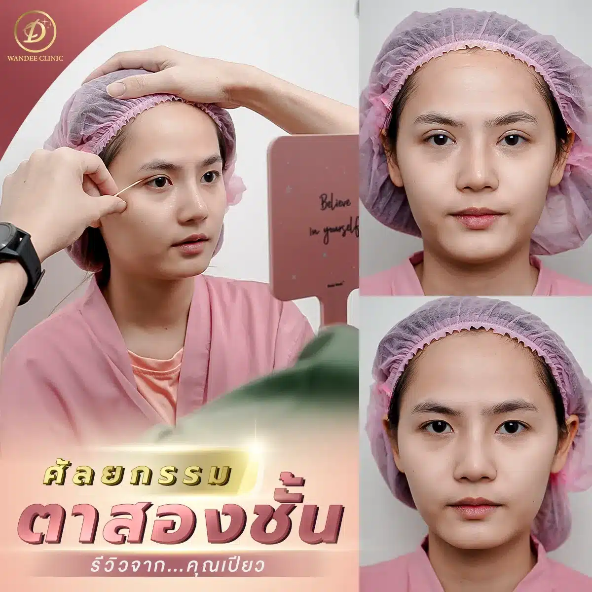 ศัลยกรรม ตาสองชั้น ขอนแก่น