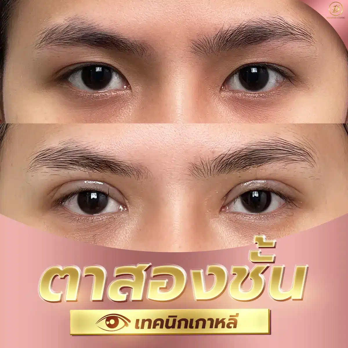 ศัลยกรรม ตาสองชั้น ขอนแก่น