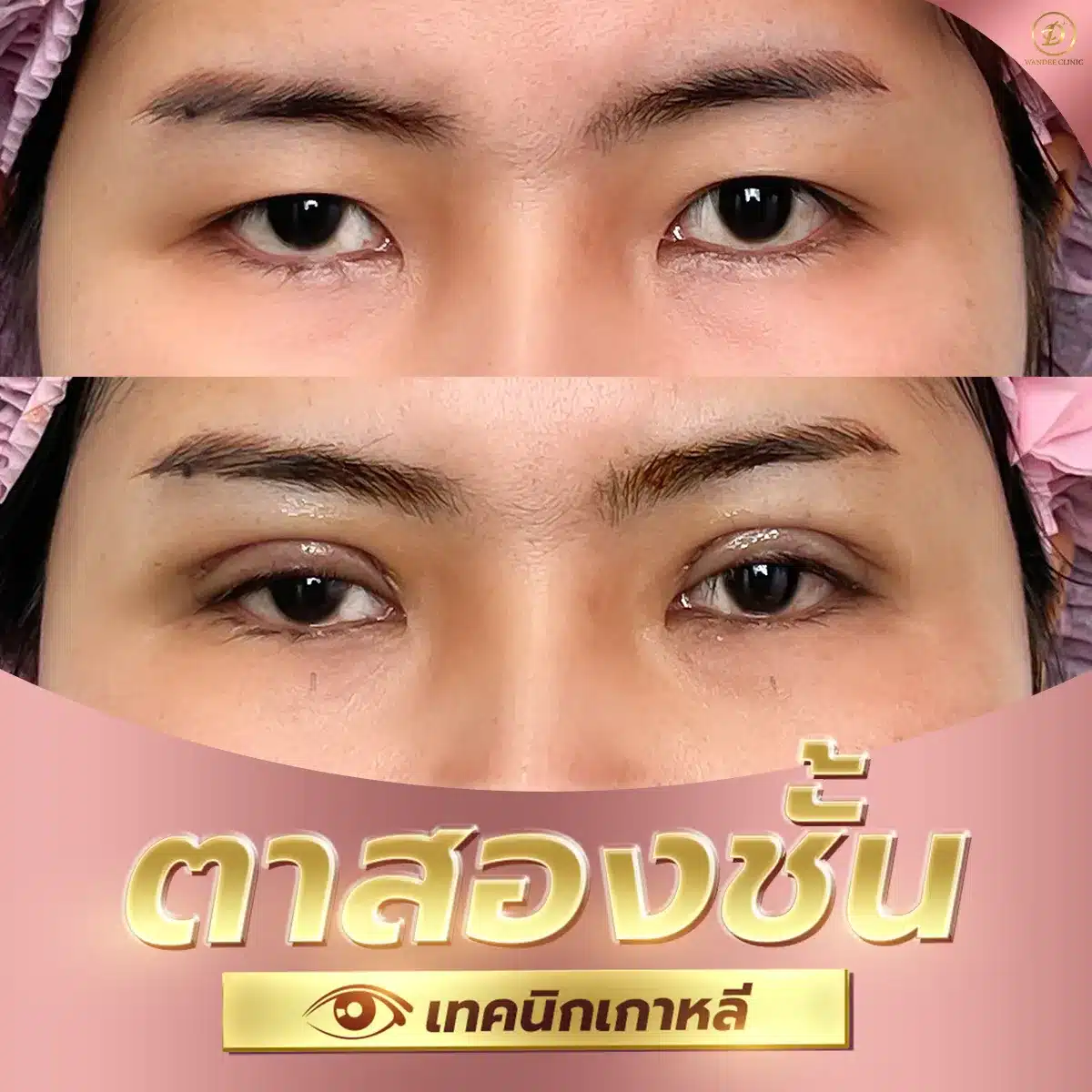 ศัลยกรรม ตาสองชั้น ขอนแก่น