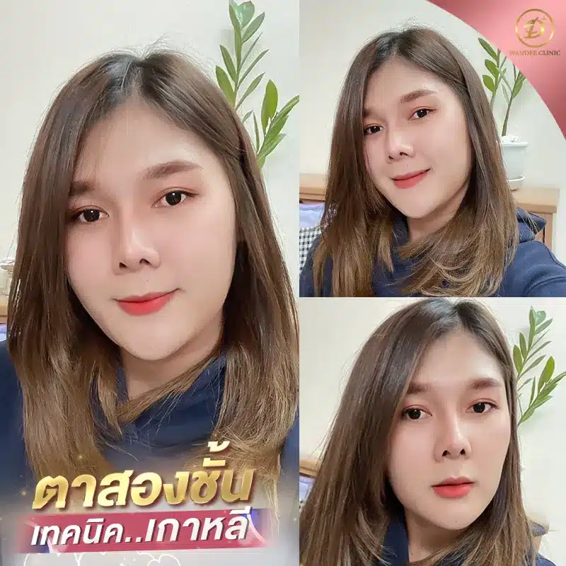 ศัลยกรรม ตาสองชั้น ขอนแก่น