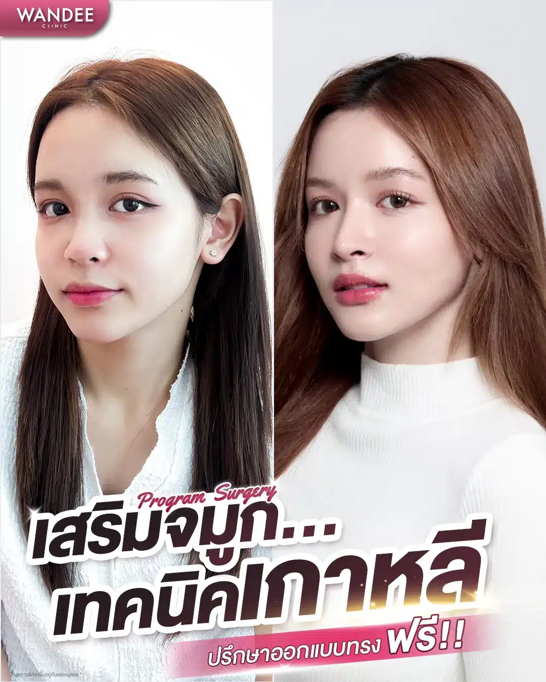 ศัลยกรรมเสริมจมูก Wandee Clinic ขอนแก่น