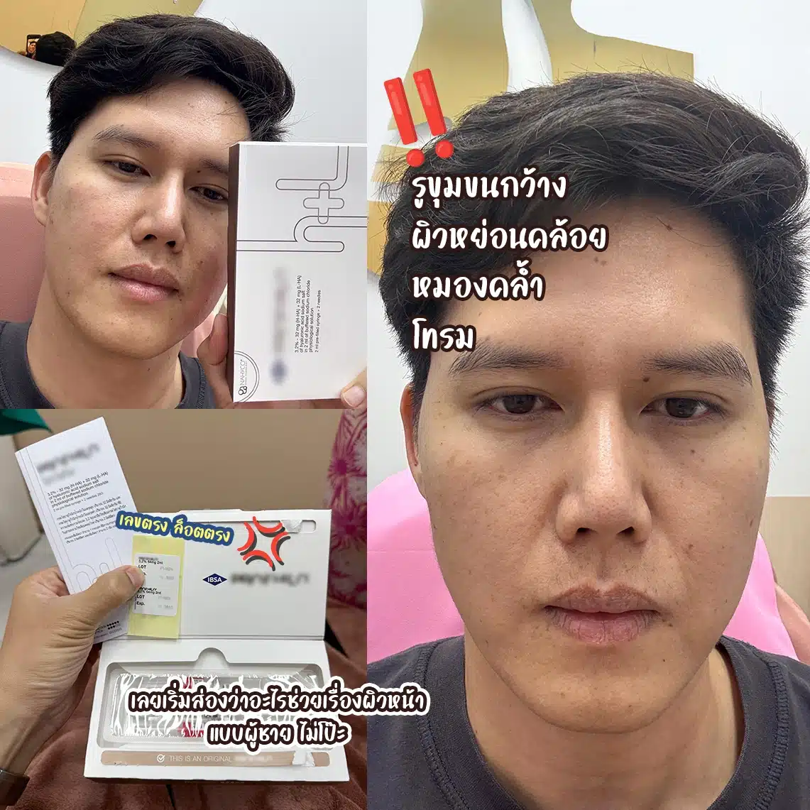 ผู้ชาย ฉีด Profhilo ได้มั้ย