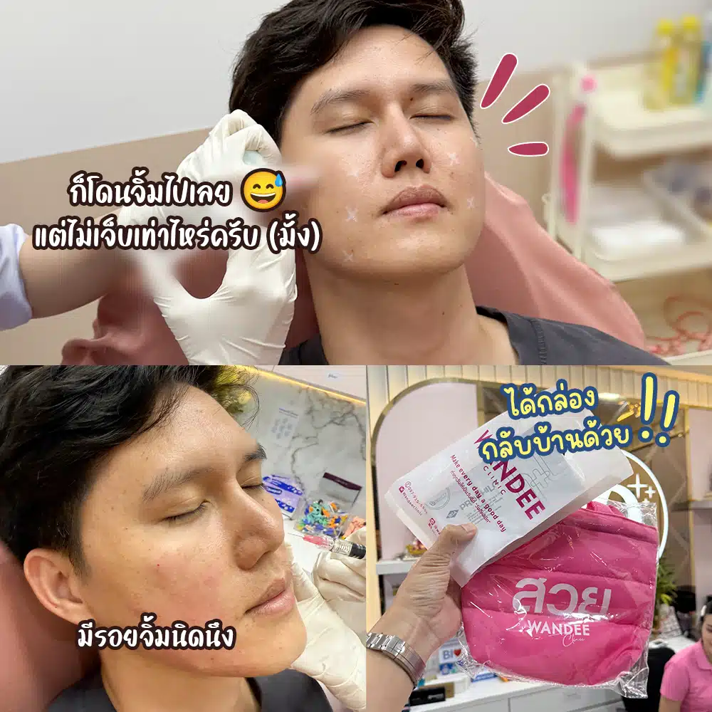 ผู้ชาย ฉีด Profhilo ได้มั้ย