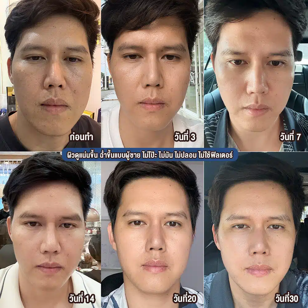 ผู้ชาย ฉีด Profhilo ได้มั้ย