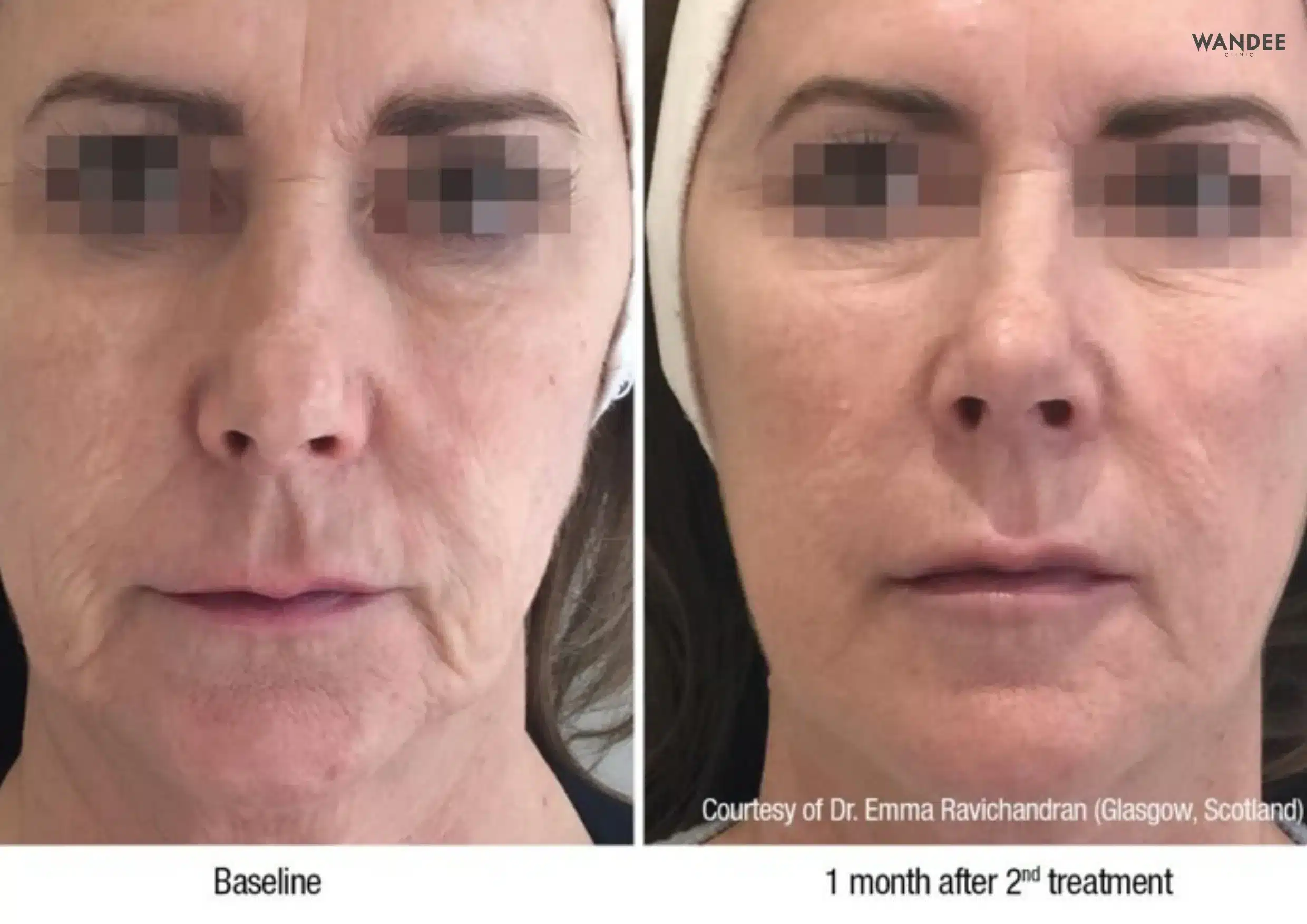 บริเวณที่นิยมฉีด Profhilo