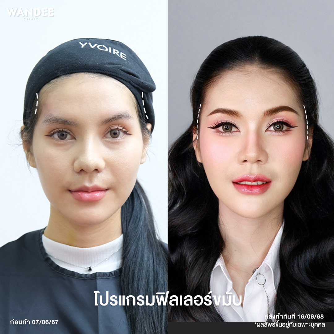 รีวิว Filler ขมับ Wandee Clinic