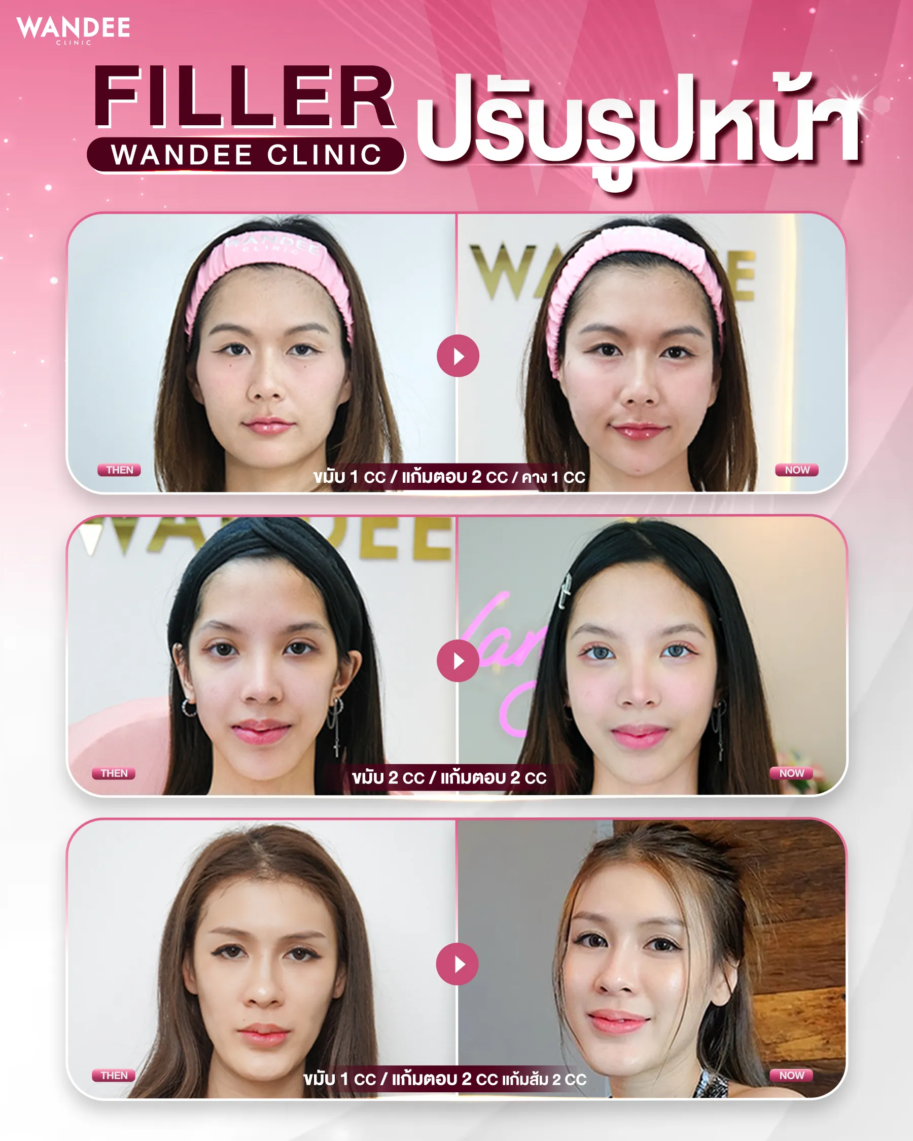 รีวิว Filler ปรับรูปหน้า Wandee Clinic