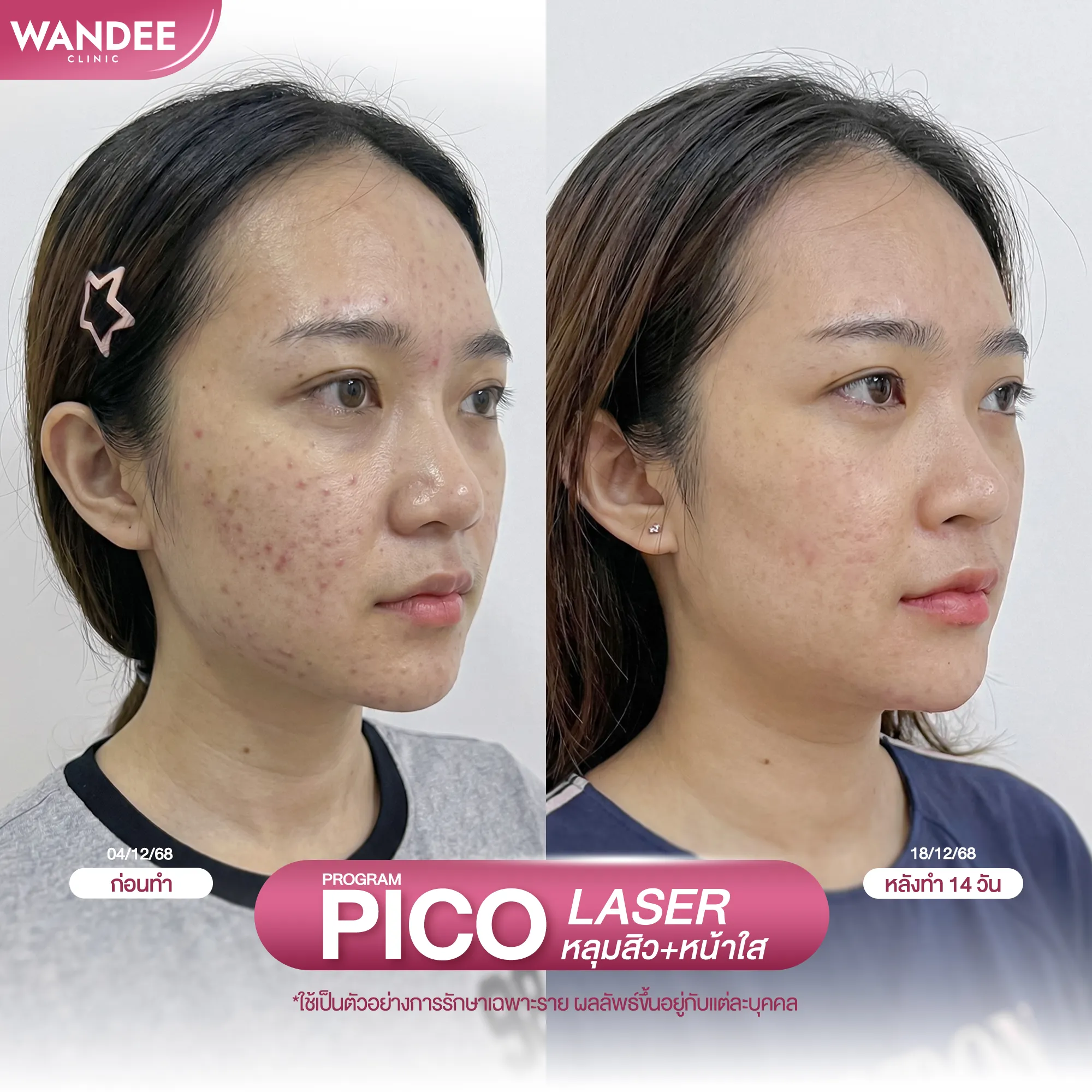 รีวิวโปรแกรม pico ที่ Wandee Clinic