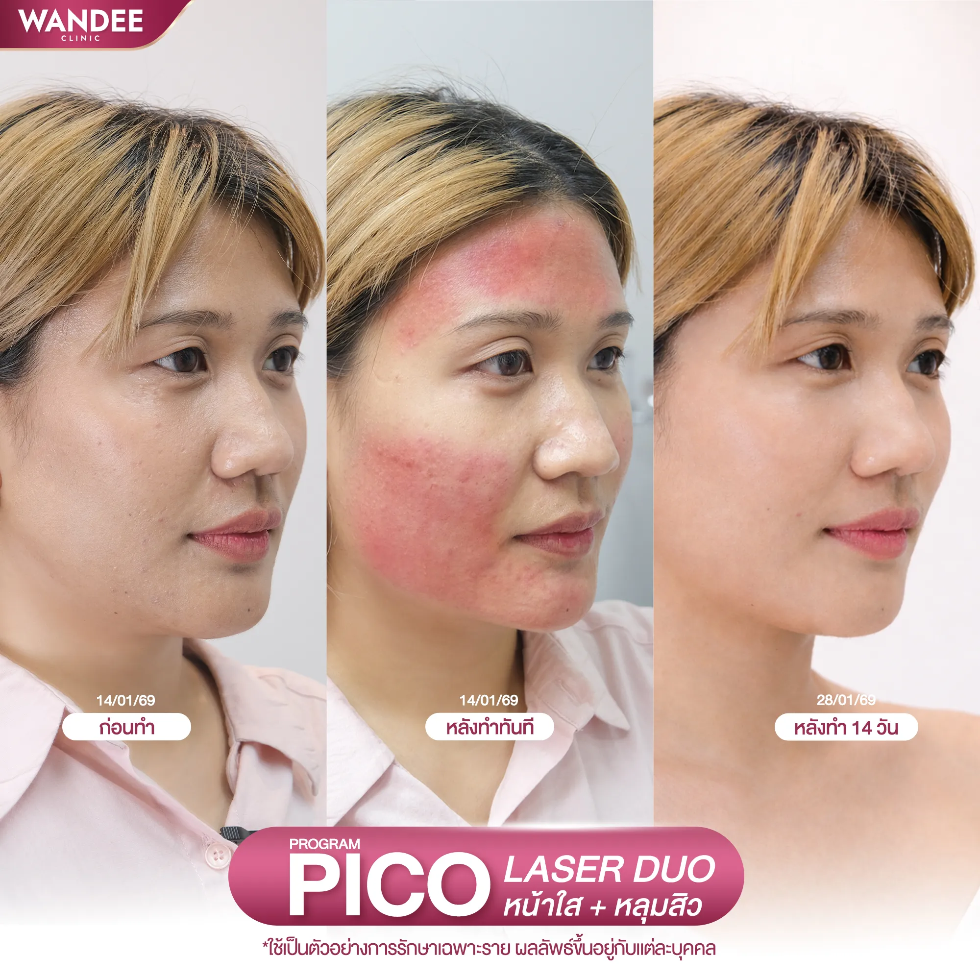 รีวิวโปรแกรม pico ที่ Wandee Clinic