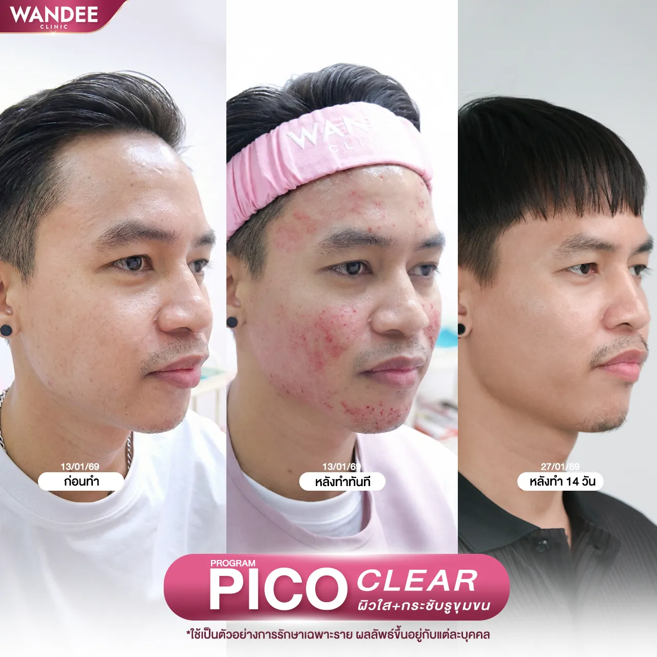 รีวิวโปรแกรม pico ที่ Wandee Clinic