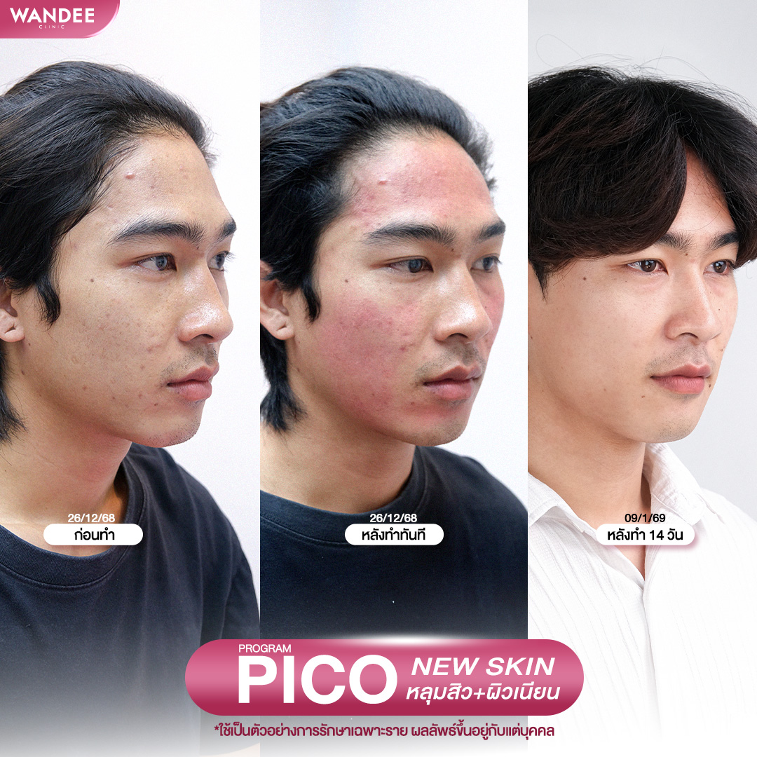รีวิวโปรแกรม pico ที่ Wandee Clinic