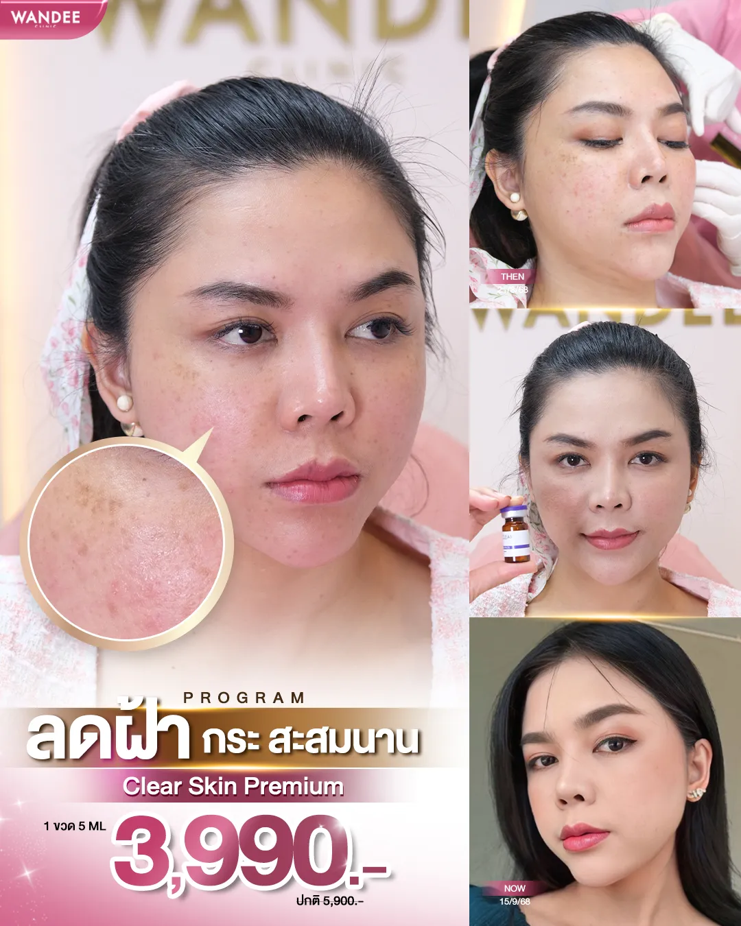 ราคา NeoClear ขอนแก่น