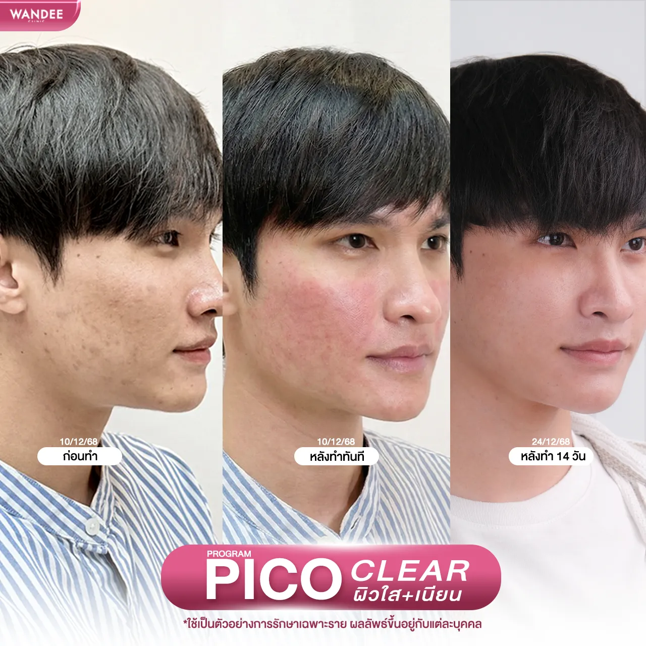 รีวิวโปรแกรม pico ที่ Wandee Clinic