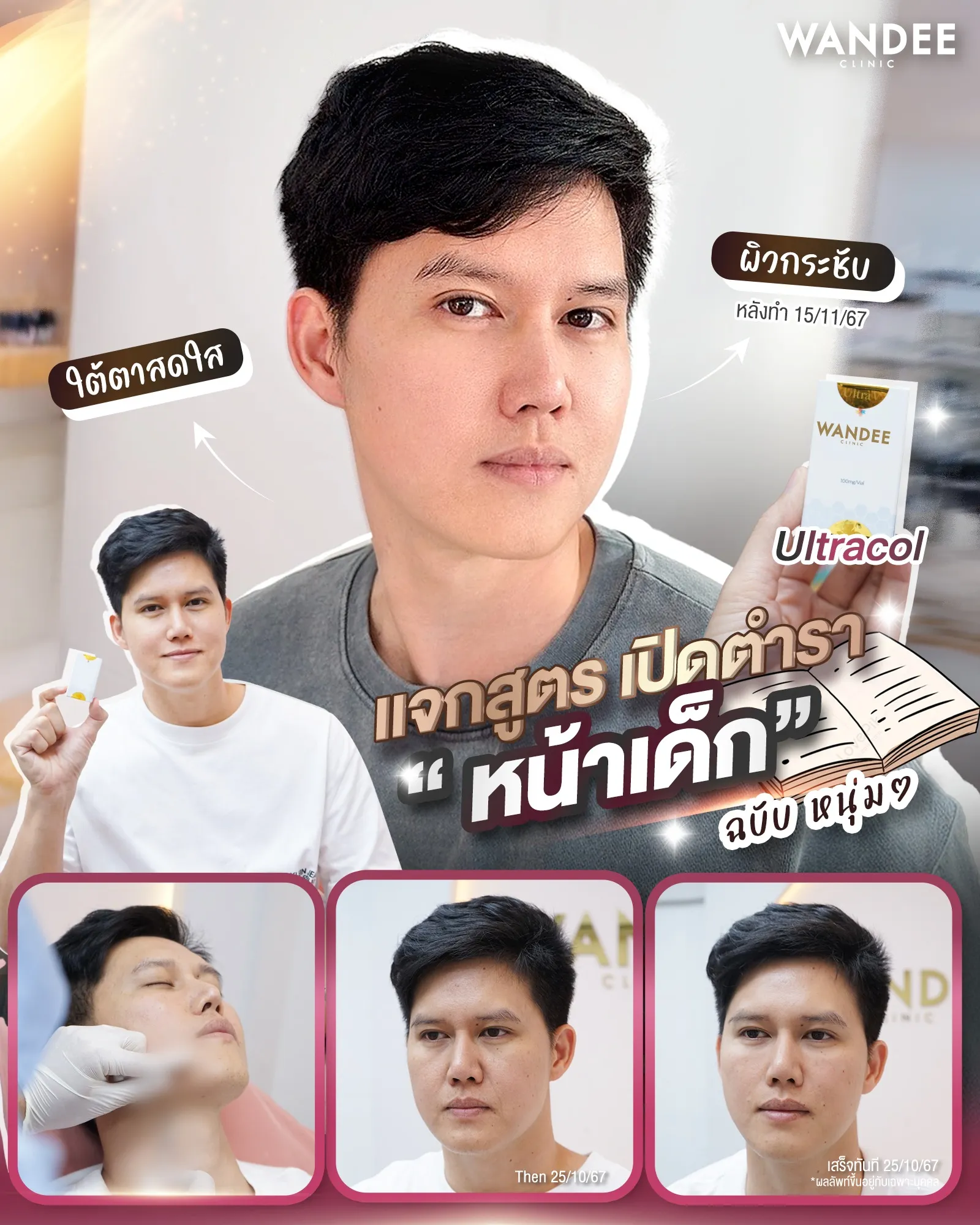 Ultracol ขอนแก่น เทียบกับ Sculptra และ Radiesse แบบไหนดีกว่า